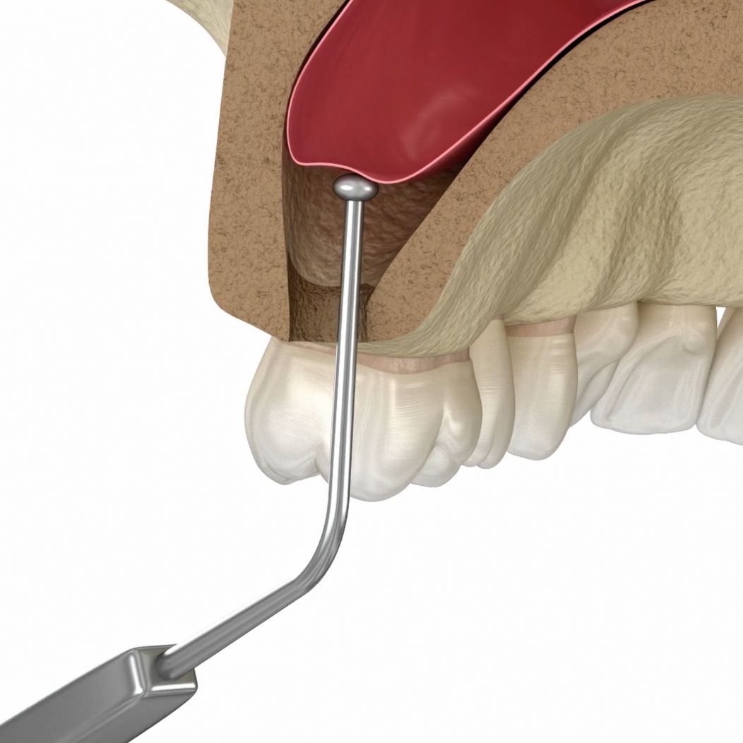 Sinus Lift & Closure Surgery Cary & Fuquay-Varina, NC | South Wake